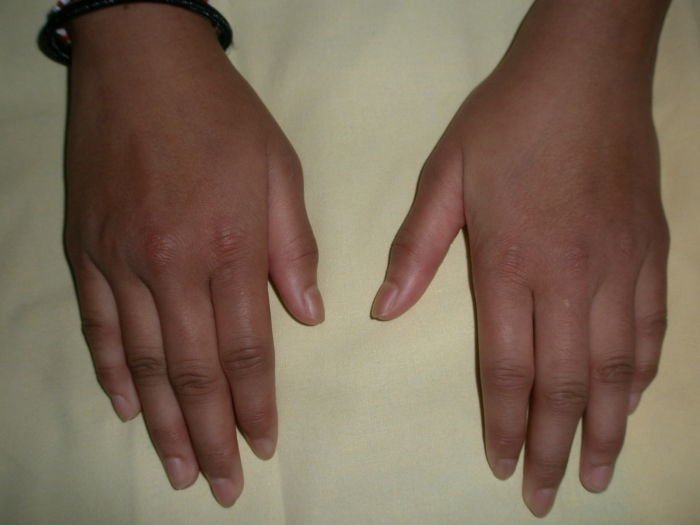 Что означают опухшие пальцы рук?